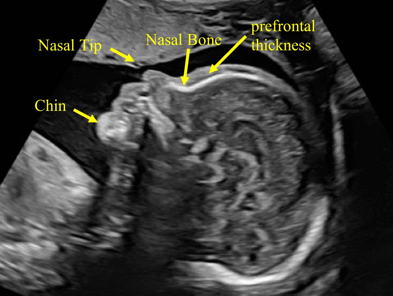 Ultrasound Evaluation of Normal Second-Trimester Fetal Anatomy